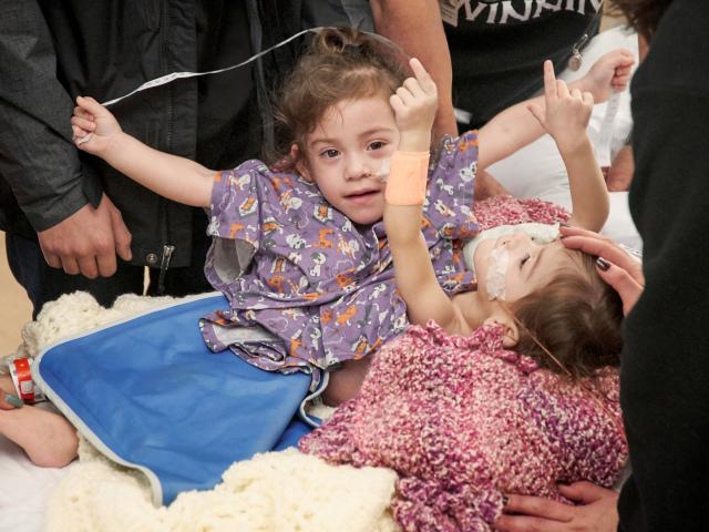 Conjoined twins Erika and Eva Sandoval before their separation surgery. Photo: Reuters