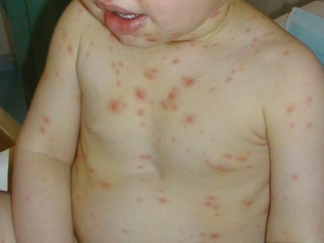 A toddler affected by chickenpox. Photo: SDHB