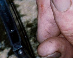 An evidence photo of Robin Bain's hand showing marks on his thumb which the TV3 documentary said...