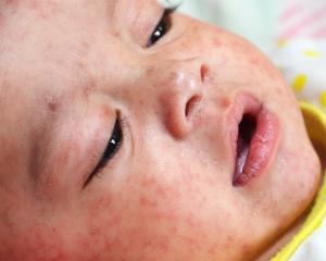 A baby with measles. Photo: Ministry of Health