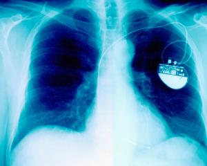 A pacemaker helps regulate the heart's natural rhythm. Photo: Getty Images 