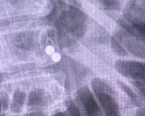 An X-ray showing magnets (File photo). Photo: Supplied