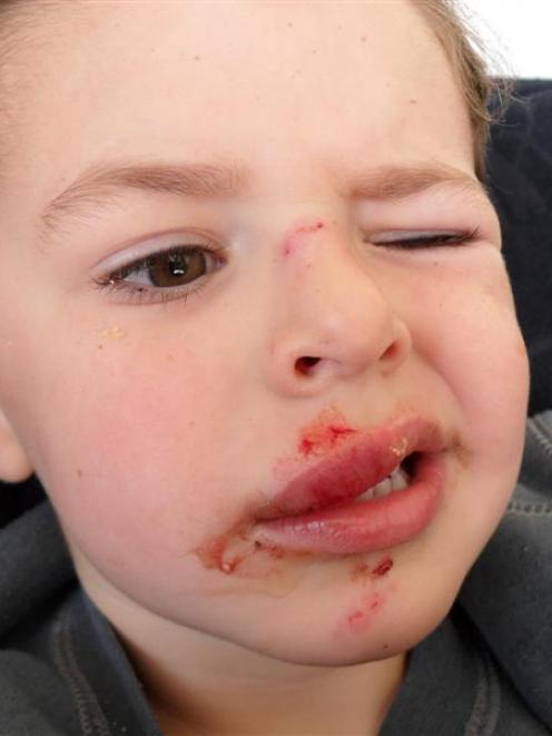 A Police dog attack left Tyler Hatton with two minor puncture wounds on his lip and a "minor gash...