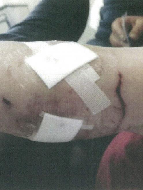 A Queenstown boy's leg after he was bitten by two dogs. Photo from QLDC