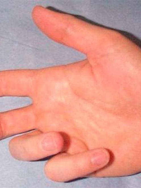 An affected hand.