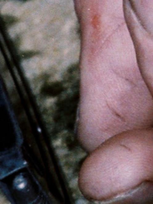 An evidence photo of Robin Bain's hand showing marks on his thumb which the TV3 documentary said...