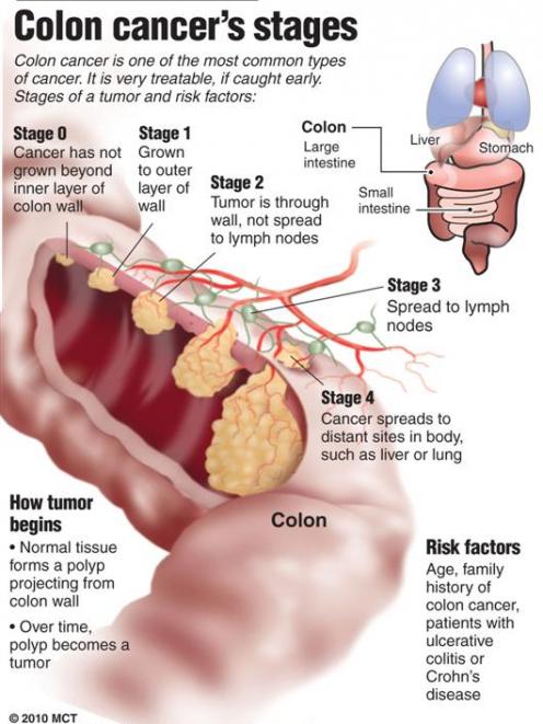 Colon Cancer Stages. MCT graphic.