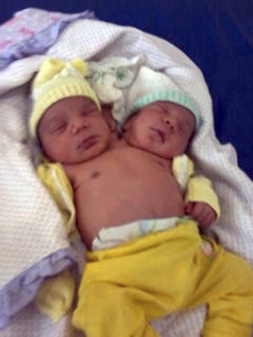 Conjoined twins Jesus and Emanuel are seen in hospital in Anajas, northern Brazil. REUTERS/JR Avelar