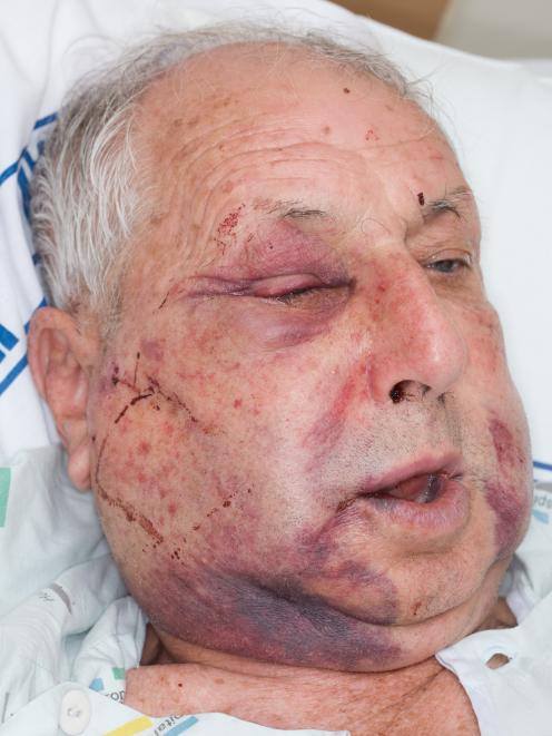 Eric Brady was left with horrific facial injuries. Photo by NZPA