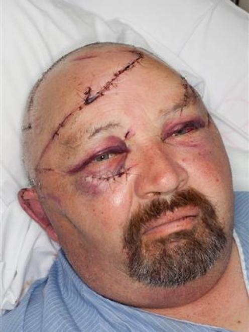 Taihape Senior Constable Bruce Mellor's injuries after he was attacked on the roadside by two...