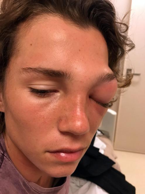 Brisbane teenager Riley Adams (15) is now blind in one eye after a sinus infection on a cruise to...