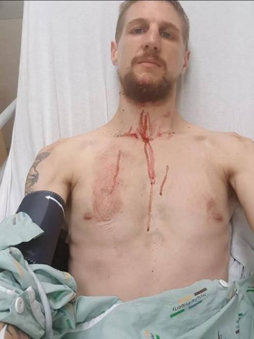 Liam Thomspon suffered a broken jaw and a raft of cuts and grazes. Photos: Supplied