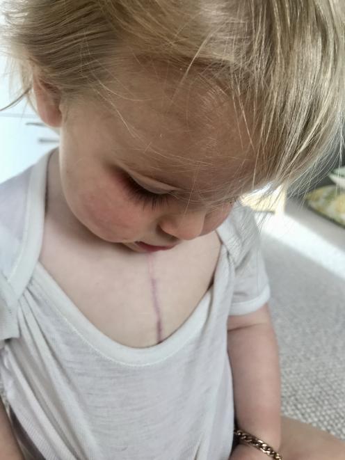 A zipper scar on her chest will forever remind Ida of her heart condition.