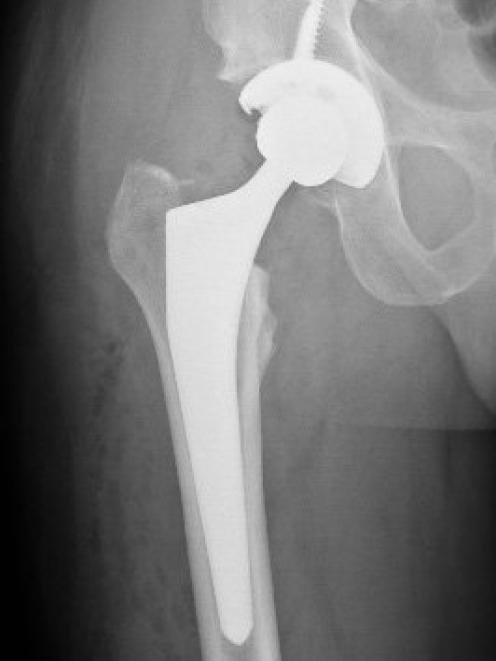 An x-ray of the replacement hip socket securely screwed and slotted into place. IMAGE: SUPPLIED