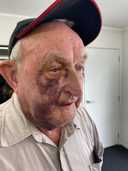 Norm was left with extensive bruising following an alleged road-rage incident last month. Photo:...
