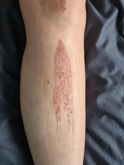 A Southland teenager has suffered burns to her leg after attempting a viral challenge based on...