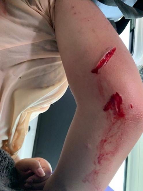 She needed 42 stitches in her right arm. PHOTO: SUPPLIED