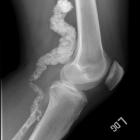 450px-ACDC_knee.jpg