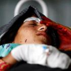 A wounded woman rests at a hospital after NATO air strikes in Laghman province, Afghanistan....