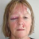 Clare Holden shows her facial injuries. Photo supplied.