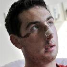 Cory Sutherland in Dunedin Hospital yesterday after being seriously assaulted last weekend. Photo...