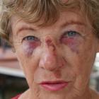 Lili Stanley, of Mosgiel, sustained injuries when she tripped in the undulating Dowling St car...
