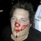 Logan Anderson after being assaulted in a random and violent attack in Dunedin on Sunday morning ...