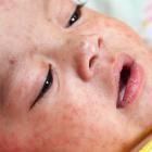 A baby with measles. Photo: Ministry of Health