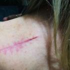 The scar from Wendy’s first wide local inci­sion surgery, which unfor­tu­nate­ly, didn’t remove...