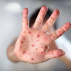It can take up to two weeks before a person starts experiencing symptoms of measles. Photo: NZ...