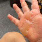 A young child's hand after being burnt on metal playground equipment. Photo: Supplied
