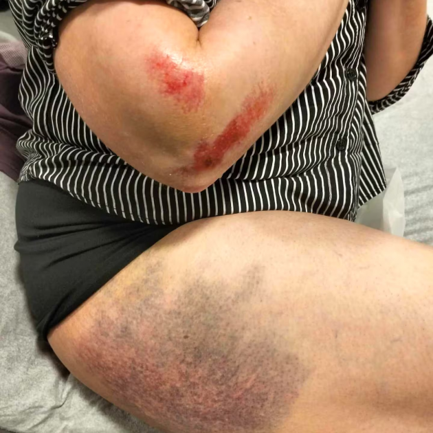 The cyclist suffered a concussion, broken bones, significant bruising and serious road rash in...