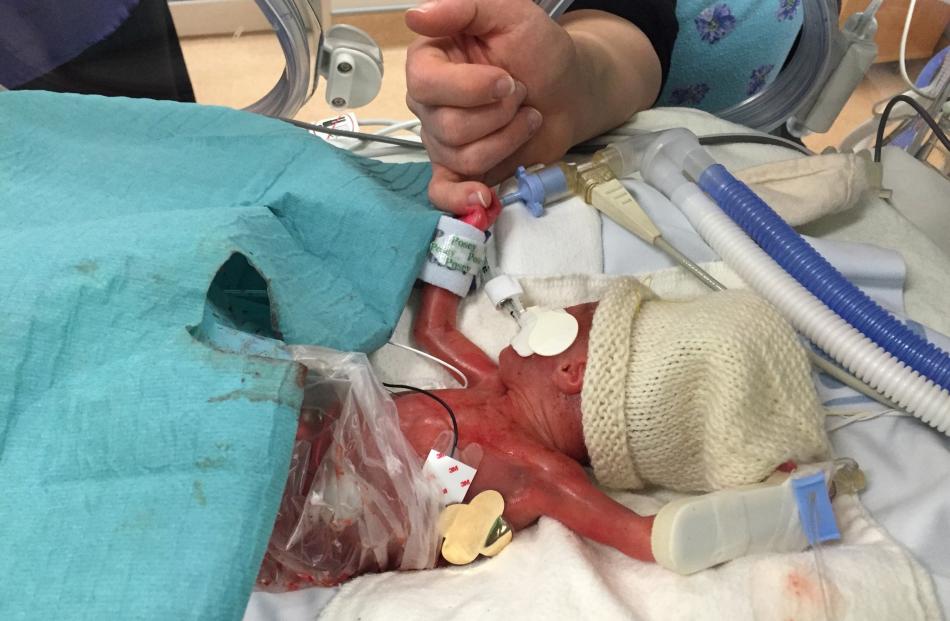 Hannah-Ruth Spence was born 16 months premature. Photo: Supplied