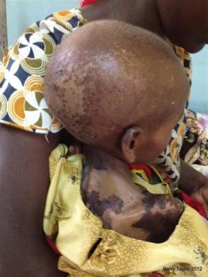 A severely malnourished child.