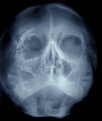 An X-ray shows the dozens of titanium screws used to 
repair a 70-year-old's head.