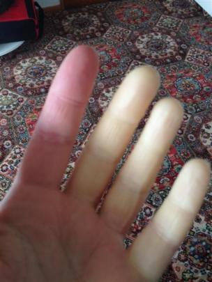 Jenny Andrews' hands show the effects of scleroderma. Photo supplied.